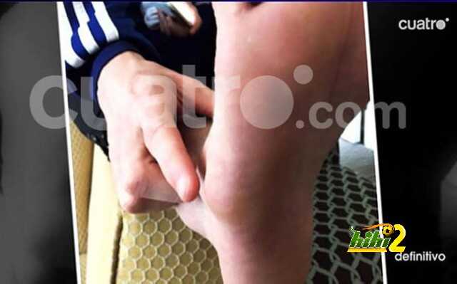 inflamacion-pie-messi-1427917935546