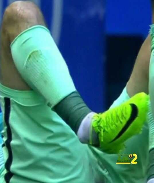 صور : اصابة اليكس فيدال التي ستبعده عن الملاعب طويلا